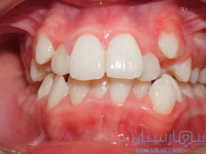لا يوجد مساحة كافية لبزوغ الأسنان مما تسبب بحدوث التزاحم