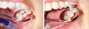 Composite fillings are a good choice for people who prefer their fillings to look like natural teeth.