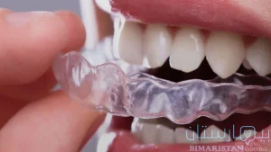 علاج ازدحام الأسنان بالتقويم الشفاف في اسطنبول