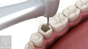 Caries removal before tooth filling